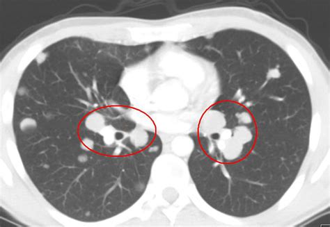 the villages lung ct scan|The Villages .